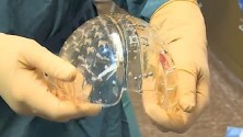 Implantation crânienne en 3D, une première mondiale