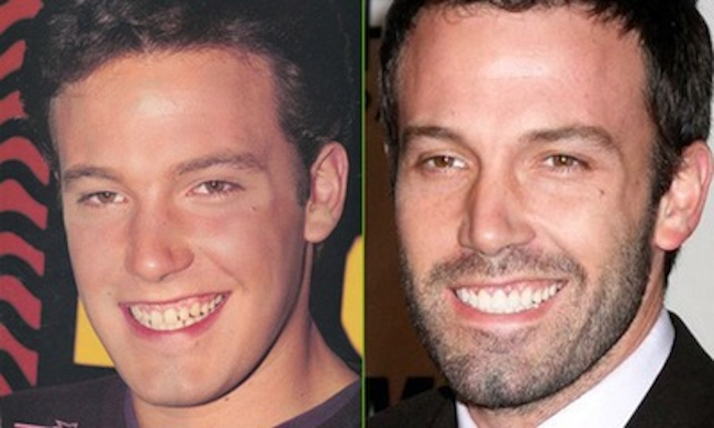 12-photos-des-dents-de-stars-avant-et-apres-une-bonne-chirurgie-dentaire