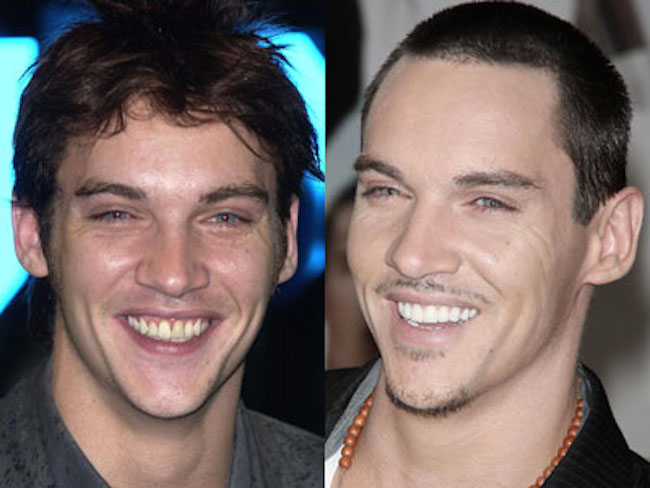 12-photos-des-dents-de-stars-avant-et-apres-une-bonne-chirurgie-dentaire10