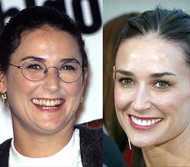 12-photos-des-dents-de-stars-avant-et-apres-une-bonne-chirurgie-dentaire6