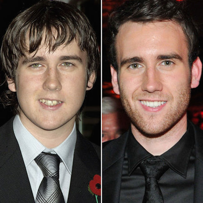 12-photos-des-dents-de-stars-avant-et-apres-une-bonne-chirurgie-dentaire7