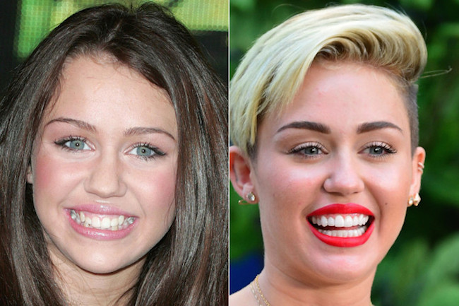 12-photos-des-dents-de-stars-avant-et-apres-une-bonne-chirurgie-dentaire9