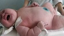 Une femme de 300 kg donne naissance au plus gros bébé au monde