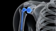 Première implantation avec succès d&rsquo;une prothèse de l&rsquo;épaule à Fqih Bensalah