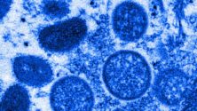 Officiel : Premier cas confirmé de la variole du singe au Maroc
